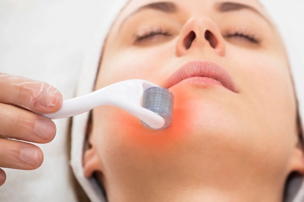 Benefits of Skin Needling