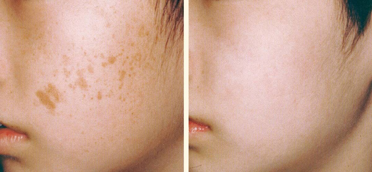Benefits of Laser Pigmentation Treatment